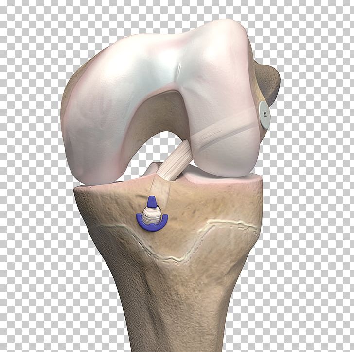 Anterior Cruciate Ligament Reconstruction Bone PNG, Clipart, Anterior Cruciate Ligament, Bone, Cruciate Ligament, Hip, Jaw Free PNG Download