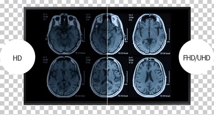 Functional Magnetic Resonance Imaging Computed Tomography Traumatic Brain Injury PNG, Clipart, Computed Tomography, Medical Supplies, Traumatic Brain Injury Free PNG Download