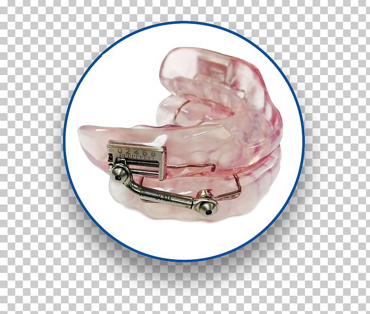 Mandibular Advancement Splint Obstructive Sleep Apnea Dentistry PNG, Clipart, Dental, Dentist, Dentistry, Dr Sharnell Muir, Fashion Accessory Free PNG Download