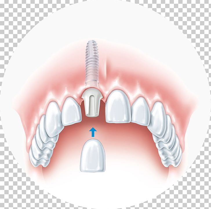 Dental Implant Dentistry Bridge PNG, Clipart, Allon4, Bridge, Brush, Cosmetic Dentistry, Dental Braces Free PNG Download