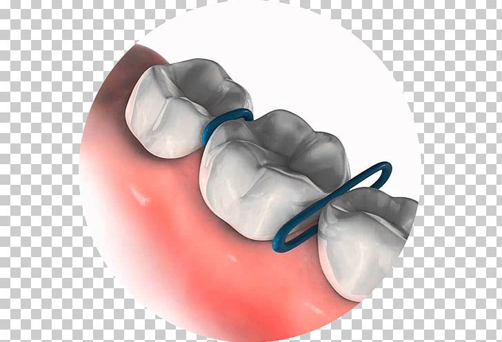 Orthodontics Dental Braces Orthodontic Spacer Orthodontic Technology Rubber Bands PNG, Clipart, Clear Aligners, Crossbite, Dental Braces, Dental Water Jets, Dentistry Free PNG Download
