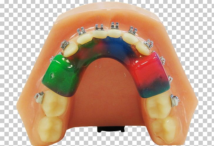 Tooth Twin Block Appliance Orthodontics Retainer Orthodontic Technology PNG, Clipart, Anterior Teeth, Appliances, Block, Buford, Dental Braces Free PNG Download
