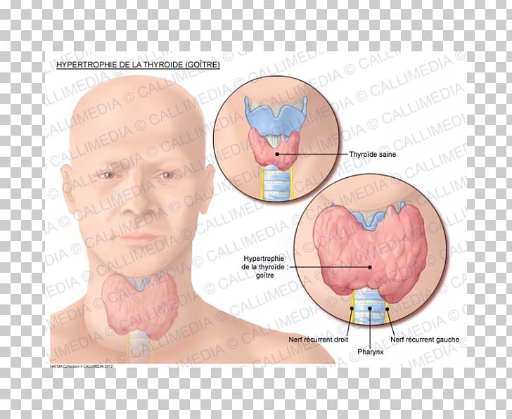 Goitre Graves' Disease Thyroid Cancer PNG, Clipart,  Free PNG Download