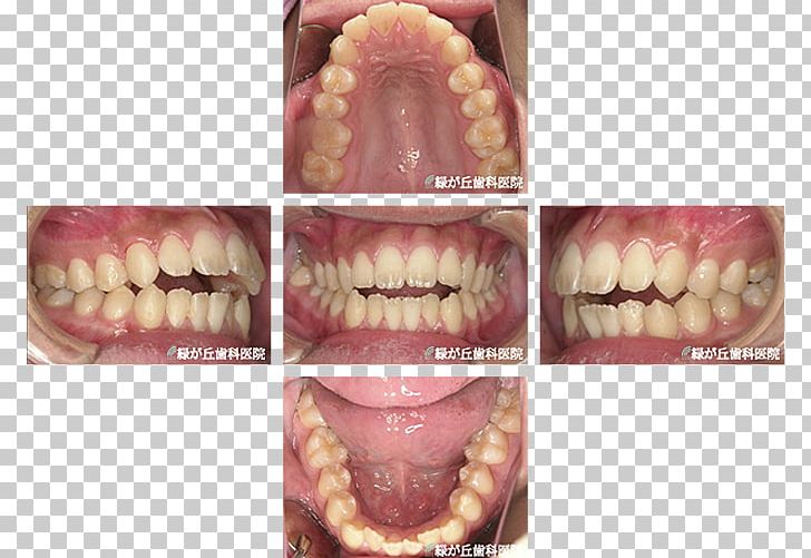 矯正歯科 Dentist Dental Braces Dentition Tooth PNG, Clipart, Crowding Of Teeth, Dental Braces, Dental Extraction, Dentist, Dentistry Free PNG Download