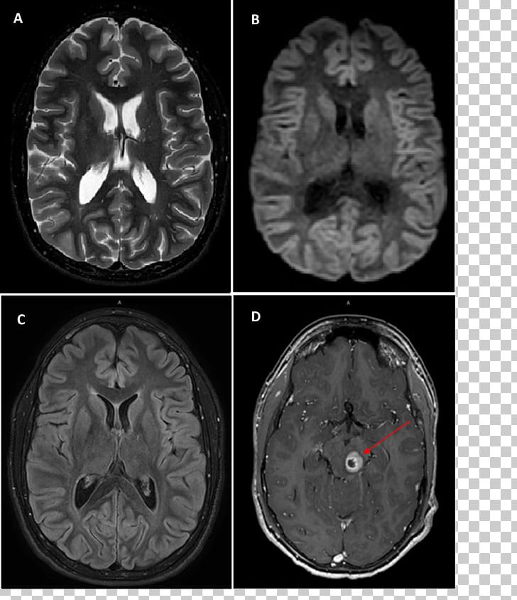 Gadoteric Acid Neurofibromatosis Type II Magnetic Resonance Imaging PNG, Clipart, Axial, Black And White, Brain, Computed Tomography, Contr Free PNG Download