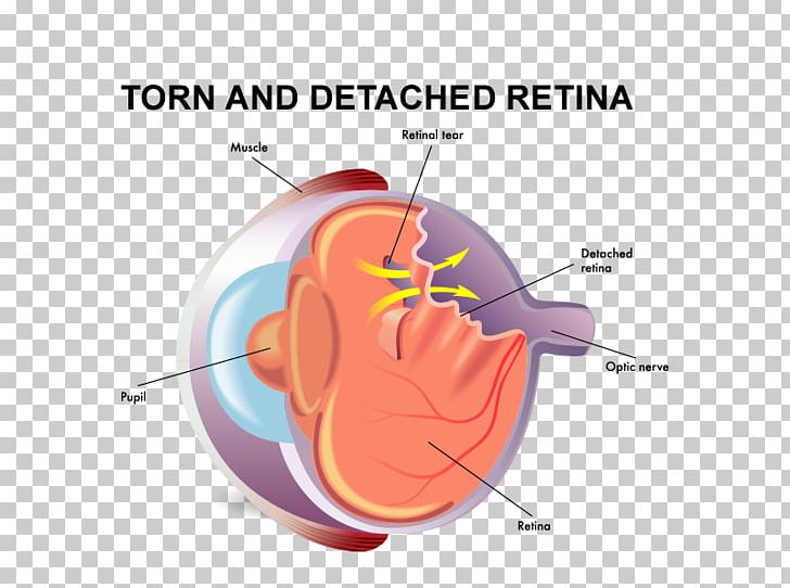 Retinal Detachment Vitreous Body Tears Eye PNG, Clipart, Angle, Diagram, Disease, Ear, Eye Free PNG Download