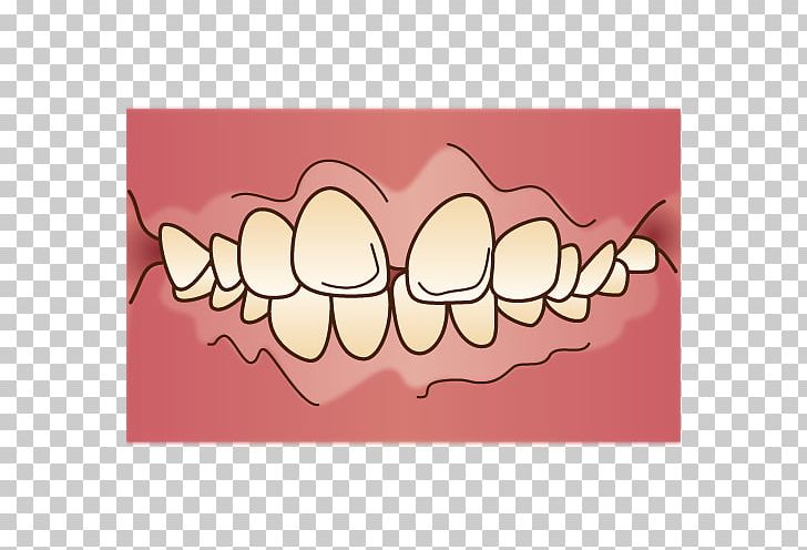 Tooth 矯正歯科 Dentist Dental Braces PNG, Clipart, Dental Braces, Dental Surgery, Dentist, Dentition, Dentures Free PNG Download