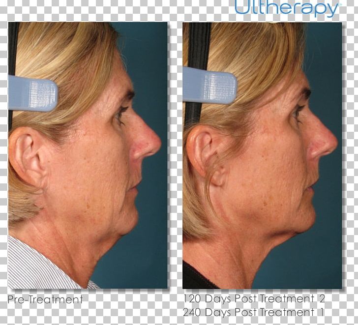 High-intensity Focused Ultrasound Therapy Medicine Surgery PNG, Clipart, Before After, Blepharoplasty, Cheek, Chin, Dermatology Free PNG Download