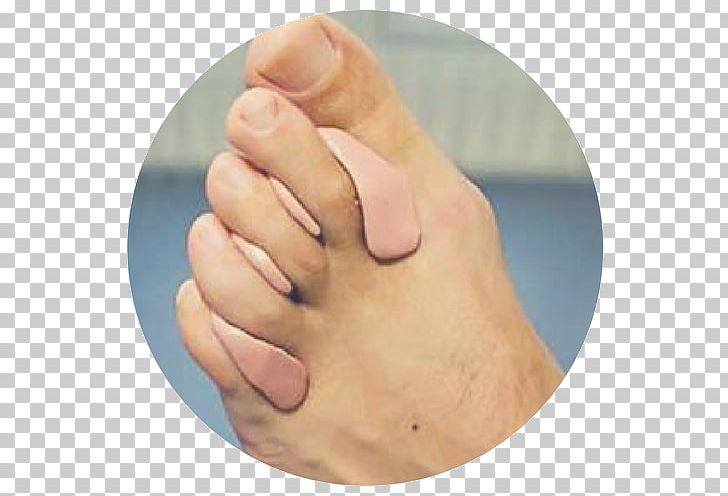 Orthotics Hammer Toe Corn Bunion PNG, Clipart, Bunion, Corn, Finger, Foot, Hallux Free PNG Download