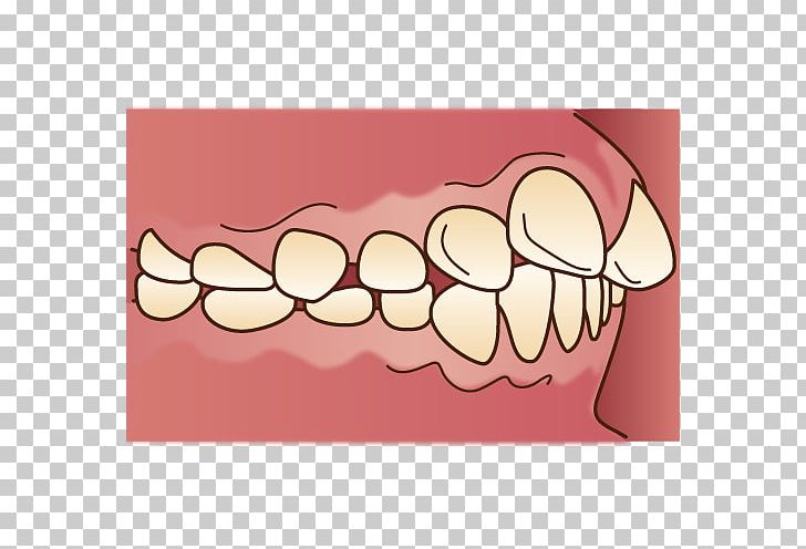 歯科 Malocclusion Dental Braces Dentition Dentist PNG, Clipart, Crossbite, Dental, Dental Braces, Dentist, Dentition Free PNG Download