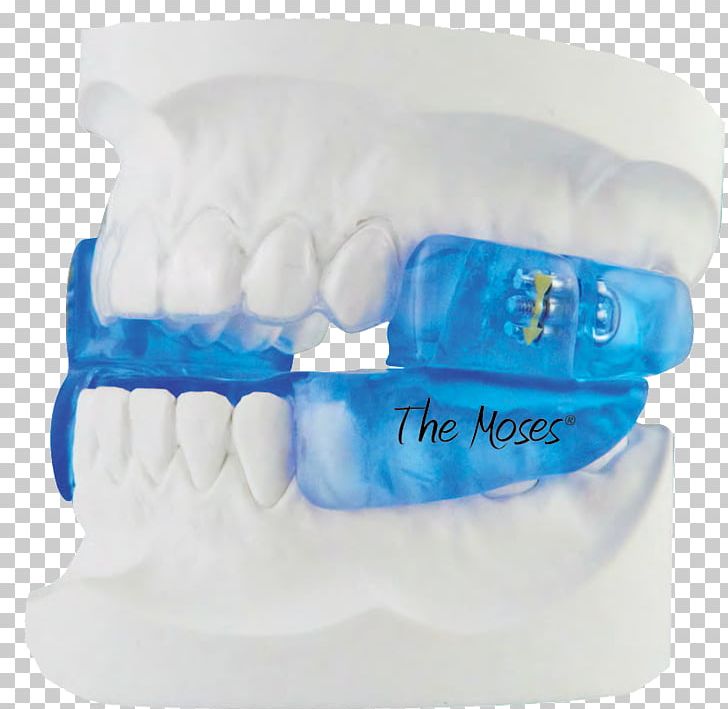 Mandibular Advancement Splint Obstructive Sleep Apnea Dentist PNG, Clipart, Apnea, Dental Architecture And Therapy, Dentist, Dentistry, Human Mouth Free PNG Download