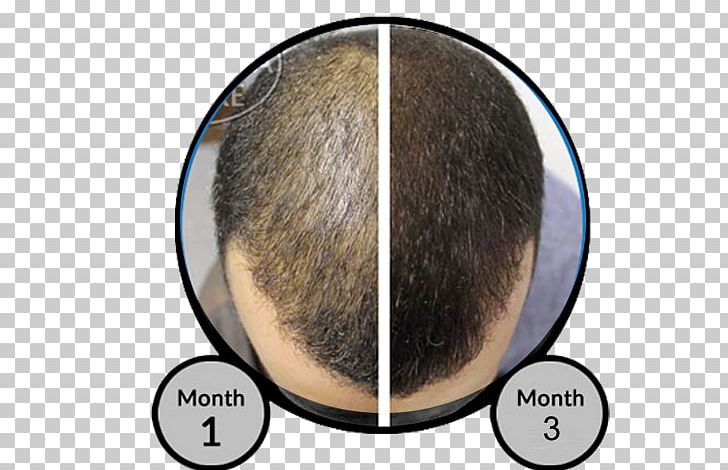 Toppik Hair Building Fibers Hair Loss Forehead PNG, Clipart, Brown Hair, Building, Chin, Dietary Supplement, Facial Hair Free PNG Download