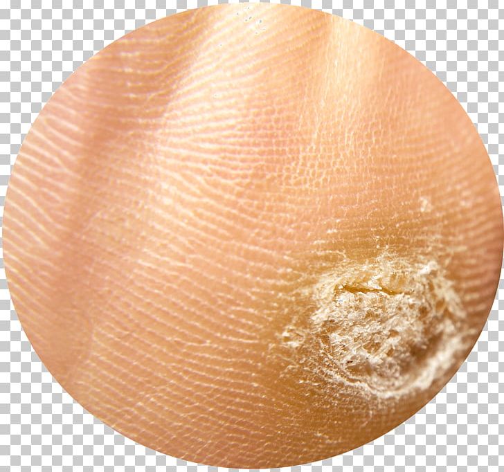 Callus Plantar Wart Foot Sole PNG, Clipart, Ball, Bunion, Callus, Corn, Dermatology Free PNG Download