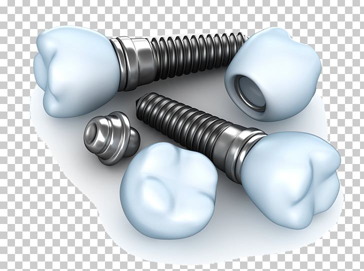 Dental Implant Dentistry Tooth PNG, Clipart, Abutment, Cosmetic Dentistry, Dental, Dental Extraction, Dental Implant Free PNG Download