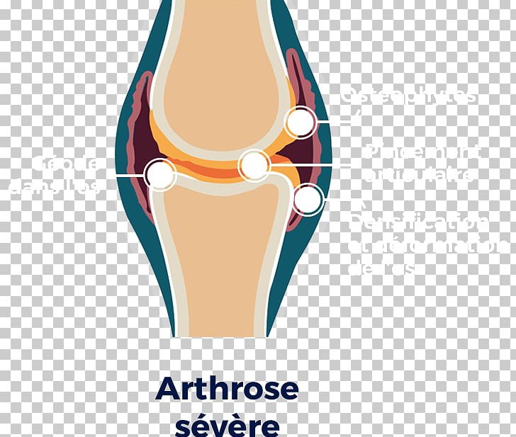Knee Osteoarthritis Knee Osteoarthritis Hip Shoulder PNG, Clipart, Cartilage, European League Against Rheumatism, Hip, Human Leg, Joint Free PNG Download