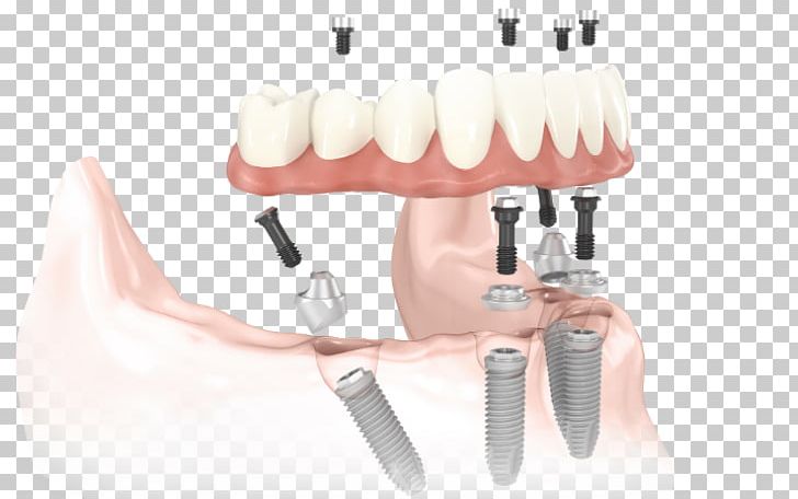 All-on-4 Dental Implant Dentistry Dentures PNG, Clipart, All On 4, Allon4, Bridge, Cosmetic Dentistry, Dental Free PNG Download
