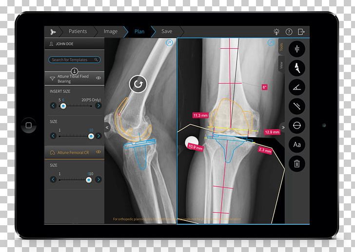 Brainlab Orthopedic Surgery Knee Replacement American Academy Of Orthopaedic Surgeons PNG, Clipart, Electronics, Gadget, Joint, Knee, Knee Replacement Free PNG Download