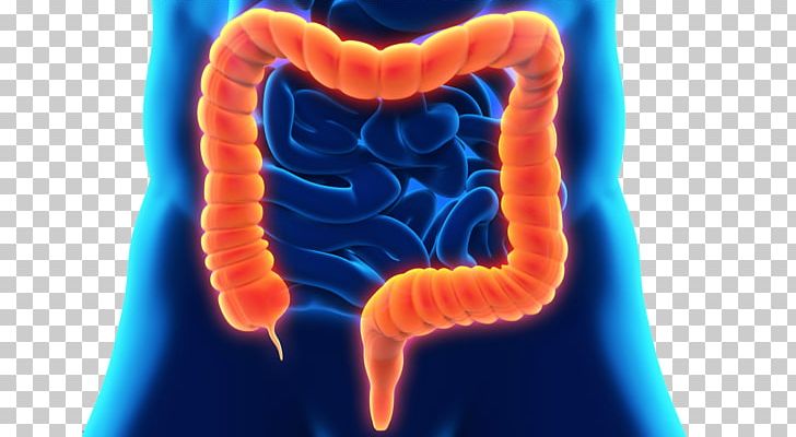Large Intestine Colon Cleansing Gastrointestinal Tract Crohn's Disease Colorectal Cancer PNG, Clipart, Bowel, Colonoscopy, Crohns Disease, Detoxification, Disease Free PNG Download