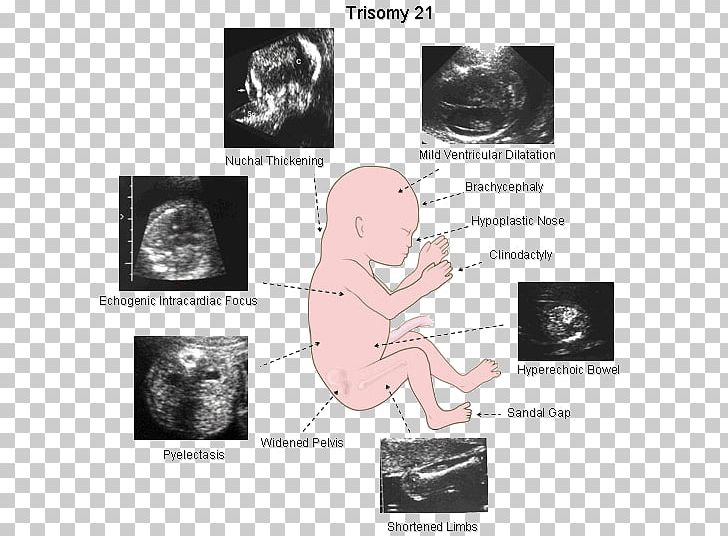 Down Syndrome Ultrasonography Sonographer Fetus PNG, Clipart, Brain, Brand, Down Syndrome, Edwards Syndrome, Fetus Free PNG Download