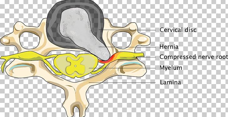 Elastic Therapeutic Tape Spinal Disc Herniation Neck Osteoarthritis Intervertebral Disc PNG, Clipart, Ache, Back Pain, Cartoon, Cervical Vertebrae, Diagram Free PNG Download