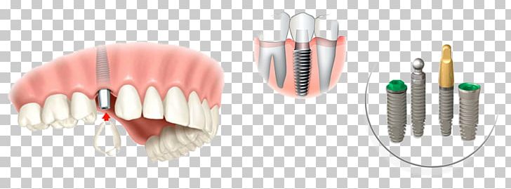 Dental Implant Dentistry Tooth Implantology PNG, Clipart, Body Jewelry, Crown, Dental Implant, Dental Laboratory, Dentistry Free PNG Download