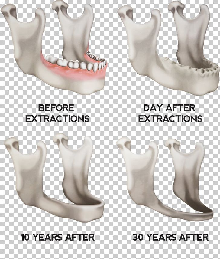 Dentures Jaw Dental Implant Tooth PNG, Clipart, Adjust, Adjustment, Arm, Bone, Dental Extraction Free PNG Download