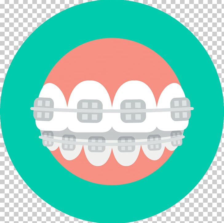 Dental Braces Dentistry Orthodontics Dental Implant PNG, Clipart, Braces, Circle, Clear Aligners, Crown, Dental Braces Free PNG Download
