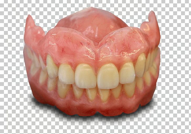 Tooth Dentures Dentistry Dental Implant Dental Laboratory PNG, Clipart, Bridge, Cosmetic Dentistry, Crown, Dental Implant, Dental Laboratory Free PNG Download