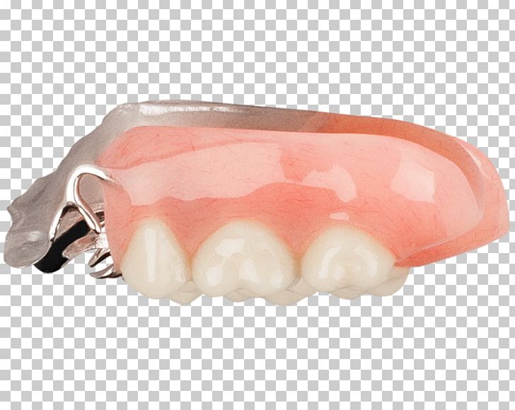 Tooth Dentures PNG, Clipart, Aspen, Cast, Dental, Dentures, Jaw Free PNG Download