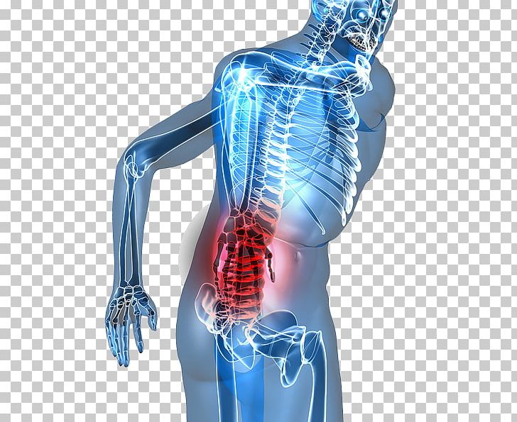 Low Back Pain Sciatica Chiropractic Chiropractor PNG, Clipart, Arm, Back Pain, Chiropractic, Chiropractor, Electric Blue Free PNG Download