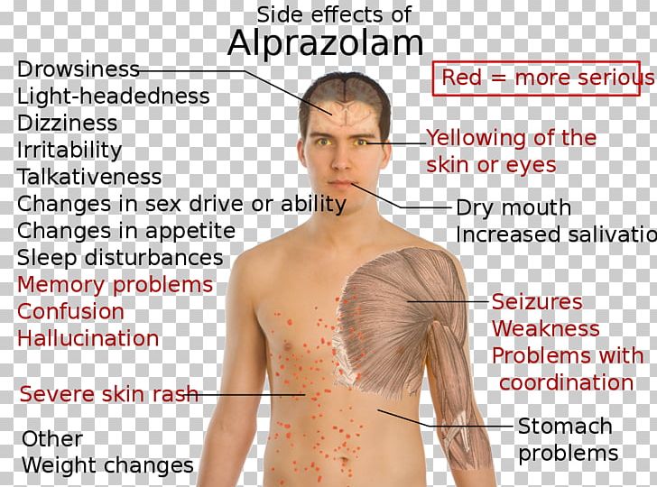 Alprazolam Adverse Effect Sleep Deprivation Pharmaceutical Drug Diazepam PNG, Clipart, Abdomen, Adverse Effect, Alprazolam, Amnesia, Arm Free PNG Download