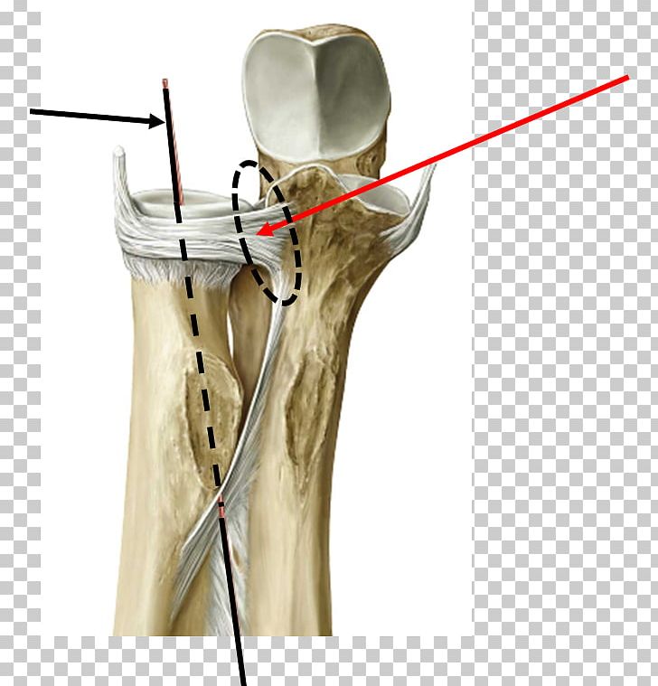 Joint Distal Radioulnar Articulation Proximal Radioulnar Articulation Ligament PNG, Clipart, Anatomy, Arm, Bone, Carpa, Distal Radioulnar Articulation Free PNG Download