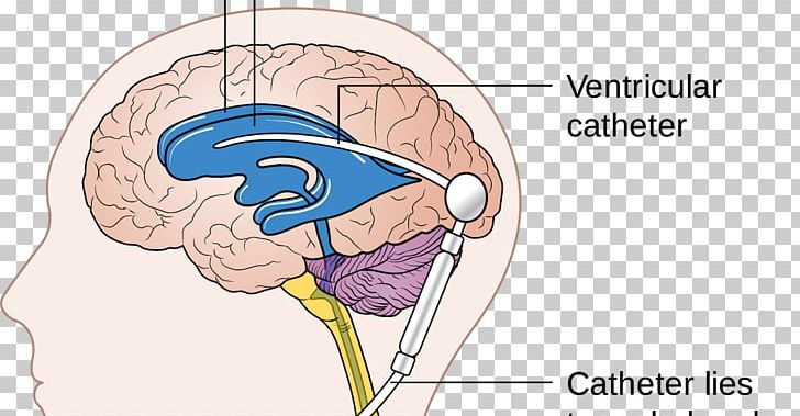 Cerebral Shunt Endoscopic Third Ventriculostomy Hydrocephalus Cerebrospinal Fluid PNG, Clipart, Angle, Brain, Cerebral Shunt, Cerebrospinal Fluid, Chiari Malformation Free PNG Download