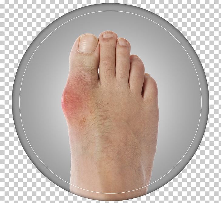 Thumb Bunion Toe Hallux Shoe Size PNG, Clipart, Ache, Bunion, Corrector, Finger, Foot Free PNG Download