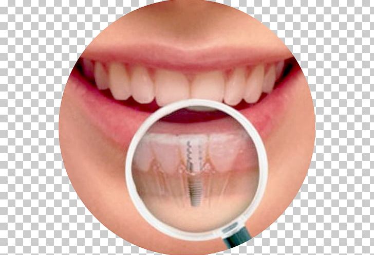 Dental Implant Human Tooth Dentistry PNG, Clipart, Bruxism, Chin, Closeup, Cosmetic Dentistry, Cyst Free PNG Download