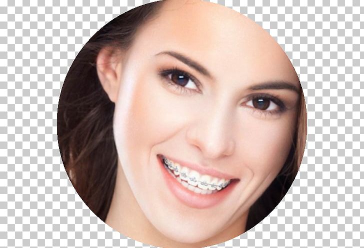 Dental Braces Orthodontics Dentistry Tooth PNG, Clipart, Beauty, Brown Hair, Cheek, Chin, Closeup Free PNG Download