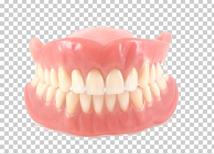 Dentures Removable Partial Denture Dentistry Dental Implant Dental Laboratory PNG, Clipart, Bridge, Cosmetic Dentistry, Crown, Dental Implant, Dental Laboratory Free PNG Download