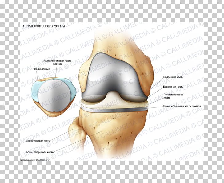 Knee Osteoarthritis Rheumatology Synovial Fluid Prosthesis PNG, Clipart, Arthritis, Bone, Bone Fracture, Cartilage, Chin Free PNG Download