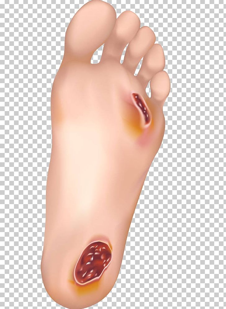 Diabetic Foot Ulcer Wound Healing Skin Ulcer PNG, Clipart, Ankle, Danger, Diabetes, Diabetes Mellitus, Feet Free PNG Download