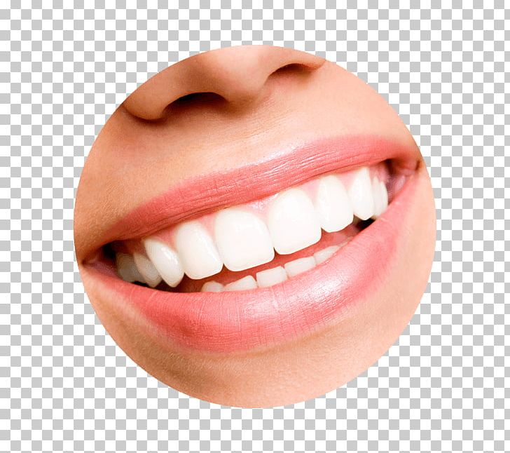 Tooth Whitening Cosmetic Dentistry Veneer PNG, Clipart, Chin, Closeup, Dental Bonding, Dental Composite, Dental Implant Free PNG Download