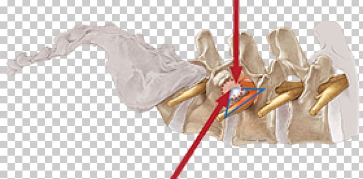Vertebral Column Surgery Spinal Disc Herniation Endoscopy Intervertebral Foramen PNG, Clipart, Arm, Arthrodesis, Cervical Vertebrae, Cms, Discectomy Free PNG Download