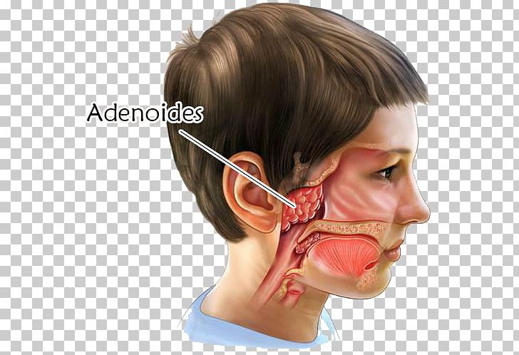 Adenoid Tonsillectomy Surgery Tonsillitis PNG, Clipart, Adenoid, Adenoidectomy, Cheek, Child, Chin Free PNG Download