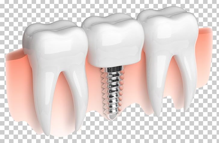 Dental Implant Dentistry Smiles On State Street PNG, Clipart, Crown, Dental Implant, Dental Technician, Dentist, Dentistry Free PNG Download