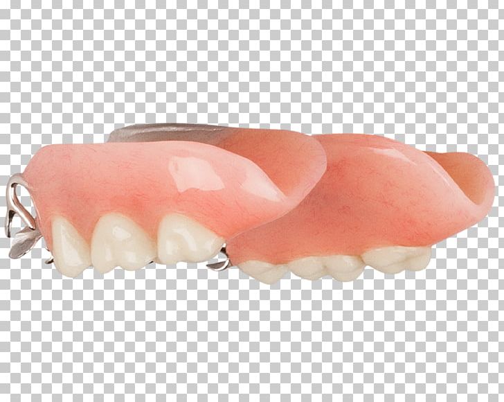 Tooth Removable Partial Denture Dentures Dentistry Aspen Dental PNG, Clipart, Aspen, Aspen Dental, Dental, Dentistry, Dentures Free PNG Download