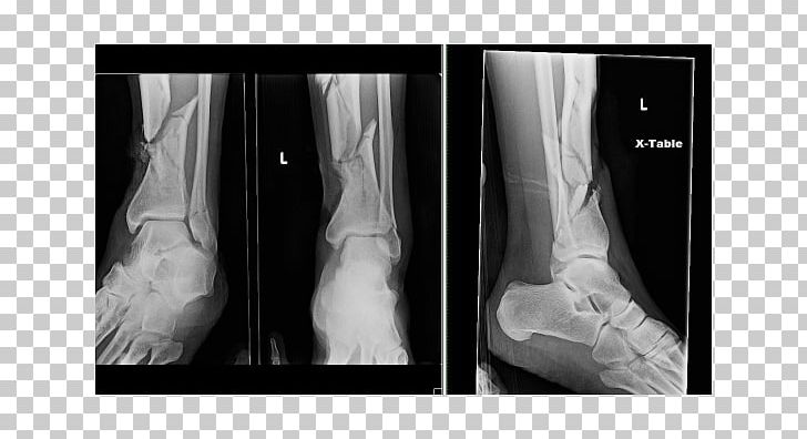 X-ray Lääketieteellinen Röntgenkuvaus Shoulder Medical Imaging PNG, Clipart, Black And White, Foot, Hip, Human Leg, Joint Free PNG Download