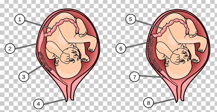 Placenta Praevia Human Fetus Uterus PNG, Clipart, Angle, Art, Birth, Cartoon, Chorion Free PNG Download