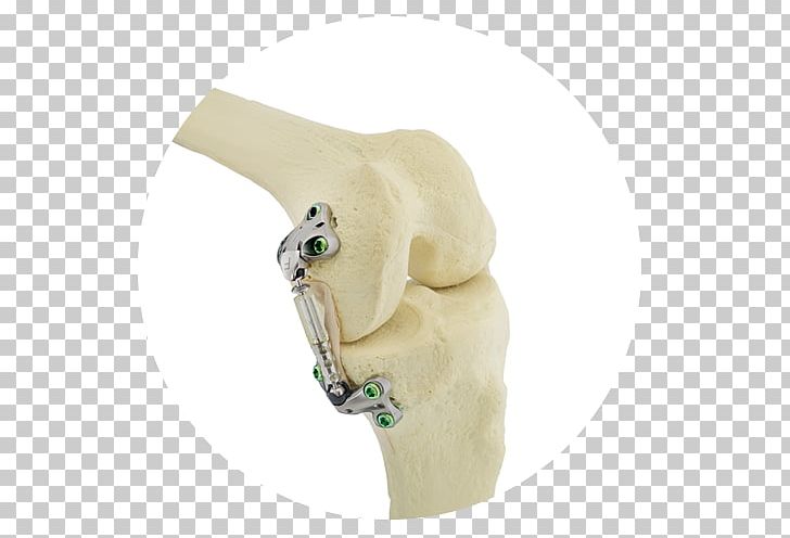 Knee Osteoarthritis Knee Osteoarthritis Knee Arthritis NASDAQ:SPNE PNG, Clipart, Business, Figurine, Joint, Knee, Knee Arthritis Free PNG Download