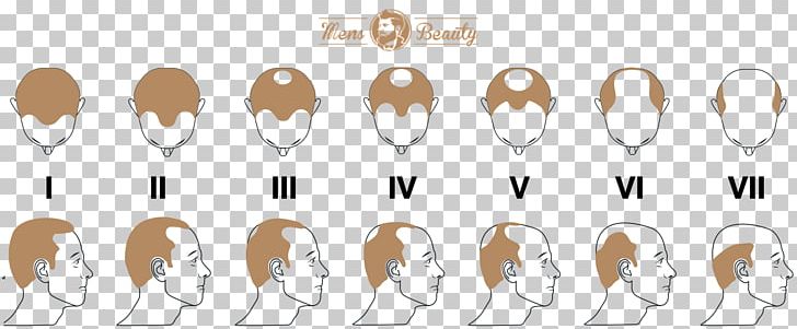 Pattern Hair Loss Hair Transplantation Hamilton–Norwood Scale PNG, Clipart, Beard, Body Hair, Botak, Ear, Finger Free PNG Download