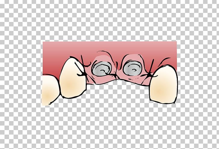 Glasses Ear Cartoon PNG, Clipart, Cartoon, Dental Implants, Ear, Eyewear, Finger Free PNG Download