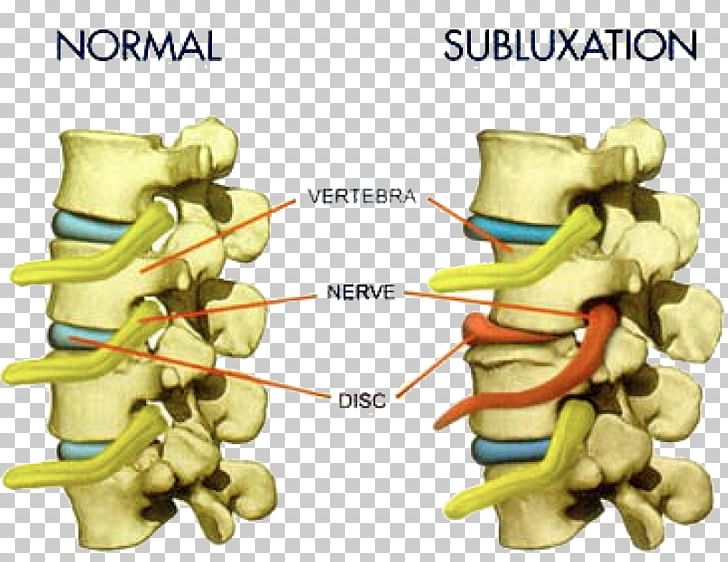 Vertebral Subluxation Chiropractic Vertebral Column Pain PNG, Clipart, Bone, Chiropractic, Chiropractor, Disease, Dr Charles Wildervanck Free PNG Download